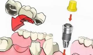 种植多少钱一颗 种植多少钱一颗